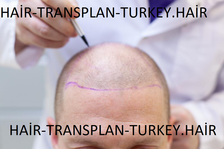 What-İs-Hair-Transplantation